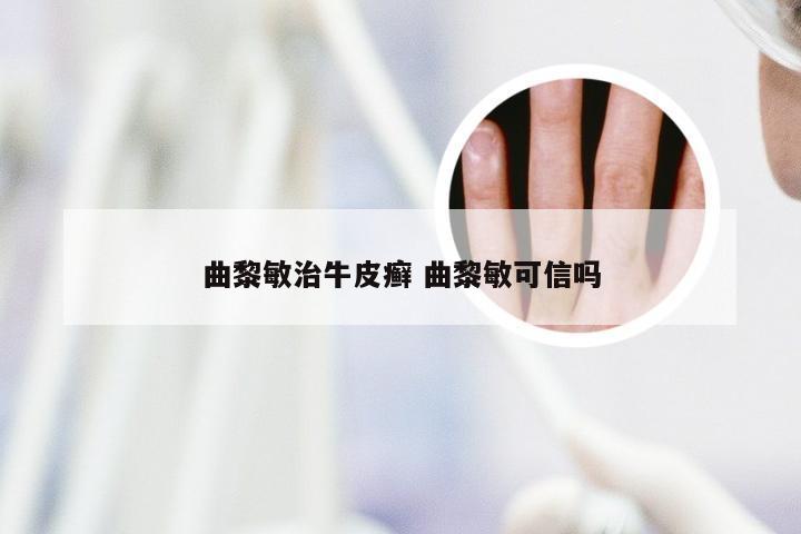 曲黎敏治牛皮癣 曲黎敏可信吗