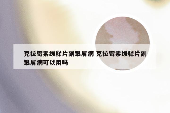 克拉霉素缓释片副银屑病 克拉霉素缓释片副银屑病可以用吗