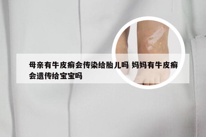 母亲有牛皮癣会传染给胎儿吗 妈妈有牛皮癣会遗传给宝宝吗
