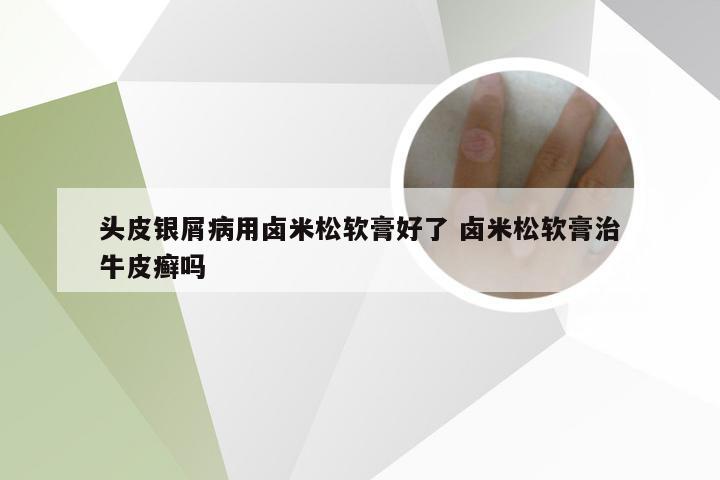 头皮银屑病用卤米松软膏好了 卤米松软膏治牛皮癣吗
