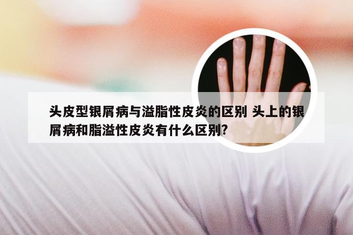 头皮型银屑病与溢脂性皮炎的区别 头上的银屑病和脂溢性皮炎有什么区别?