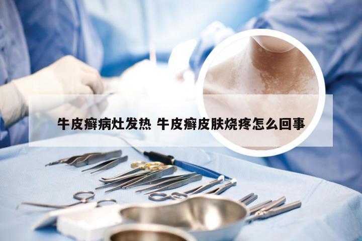 牛皮癣病灶发热 牛皮癣皮肤烧疼怎么回事