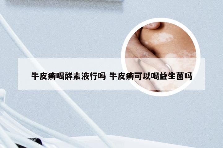 牛皮癣喝酵素液行吗 牛皮癣可以喝益生菌吗