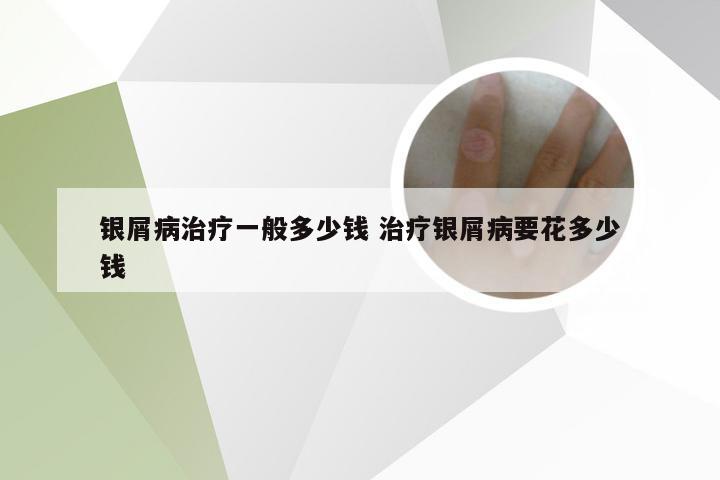 银屑病治疗一般多少钱 治疗银屑病要花多少钱