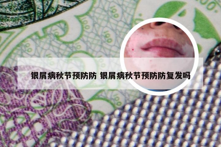 银屑病秋节预防防 银屑病秋节预防防复发吗