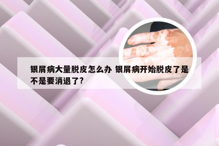 银屑病大量脱皮怎么办 银屑病开始脱皮了是不是要消退了?