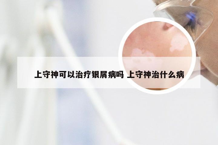 上守神可以治疗银屑病吗 上守神治什么病