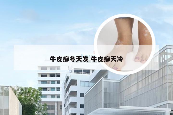 牛皮癣冬天发 牛皮癣天冷