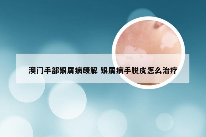 澳门手部银屑病缓解 银屑病手脱皮怎么治疗