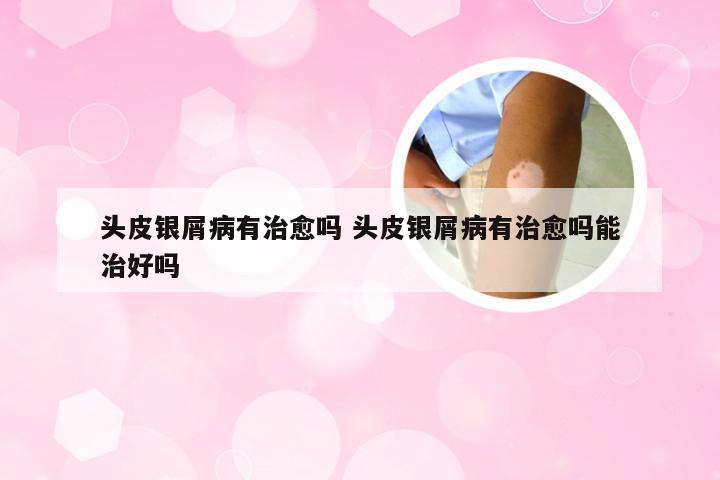 头皮银屑病有治愈吗 头皮银屑病有治愈吗能治好吗