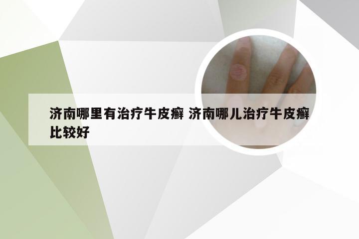 济南哪里有治疗牛皮癣 济南哪儿治疗牛皮癣比较好