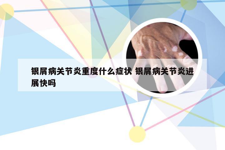 银屑病关节炎重度什么症状 银屑病关节炎进展快吗