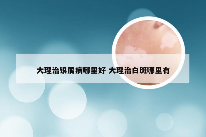 大理治银屑病哪里好 大理治白斑哪里有