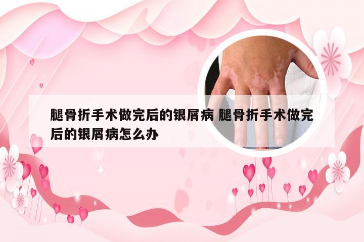 腿骨折手术做完后的银屑病 腿骨折手术做完后的银屑病怎么办