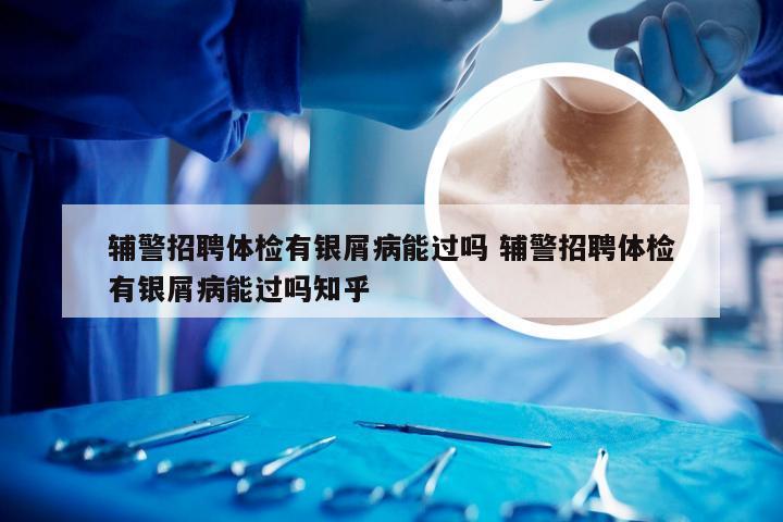 辅警招聘体检有银屑病能过吗 辅警招聘体检有银屑病能过吗知乎