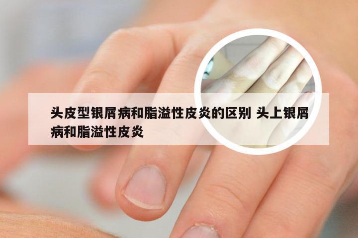 头皮型银屑病和脂溢性皮炎的区别 头上银屑病和脂溢性皮炎