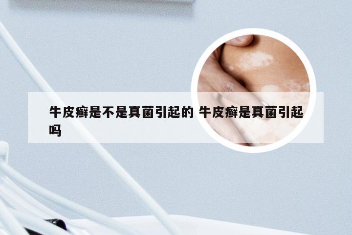 牛皮癣是不是真菌引起的 牛皮癣是真菌引起吗