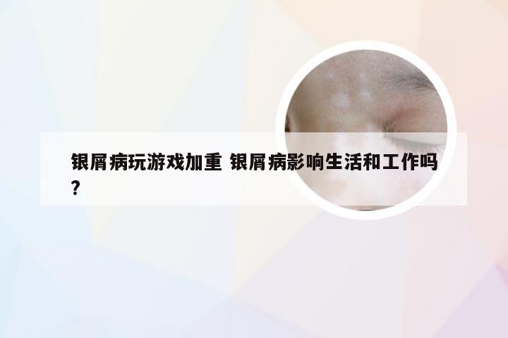 银屑病玩游戏加重 银屑病影响生活和工作吗?