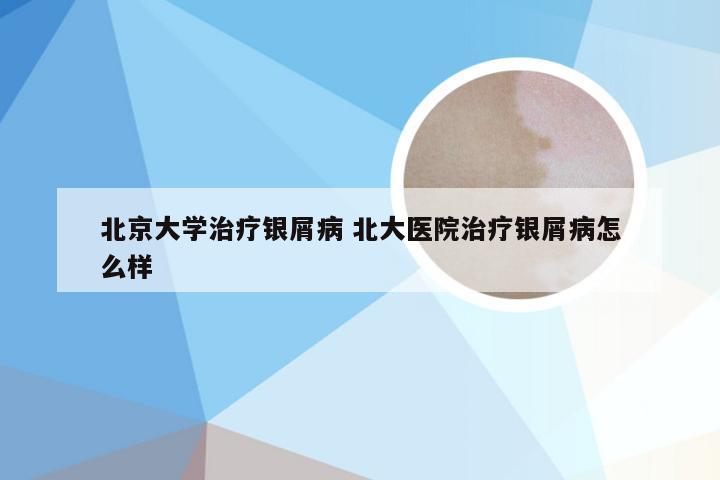 北京大学治疗银屑病 北大医院治疗银屑病怎么样
