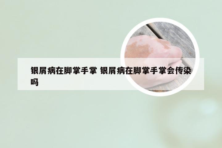银屑病在脚掌手掌 银屑病在脚掌手掌会传染吗