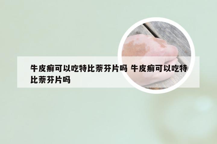 牛皮癣可以吃特比萘芬片吗 牛皮癣可以吃特比萘芬片吗