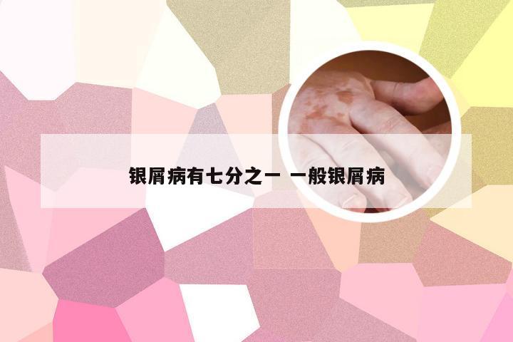 银屑病有七分之一 一般银屑病