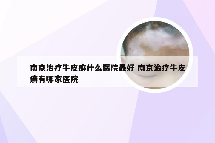 南京治疗牛皮癣什么医院最好 南京治疗牛皮癣有哪家医院