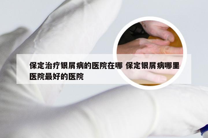 保定治疗银屑病的医院在哪 保定银屑病哪里医院最好的医院
