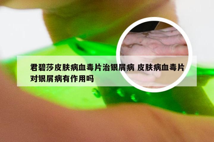 君碧莎皮肤病血毒片治银屑病 皮肤病血毒片对银屑病有作用吗