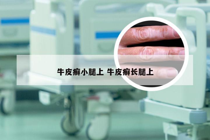 牛皮癣小腿上 牛皮癣长腿上