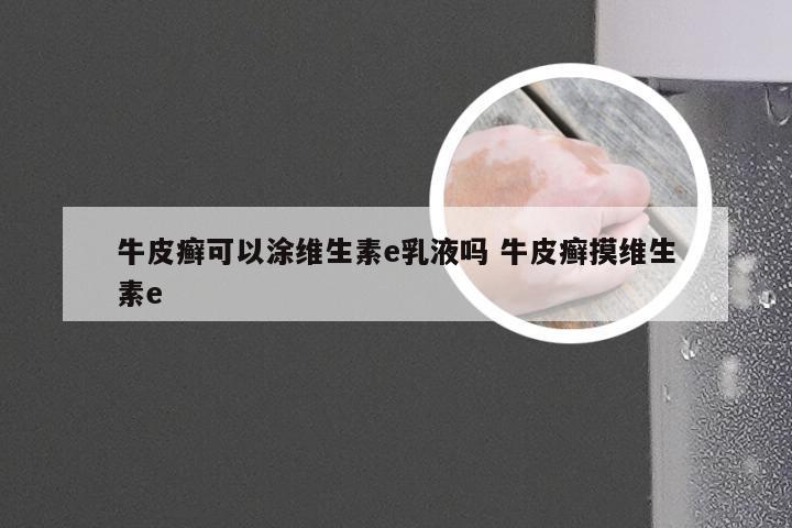 牛皮癣可以涂维生素e乳液吗 牛皮癣摸维生素e