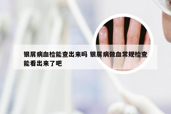 银屑病血检能查出来吗 银屑病做血常规检查能看出来了吧