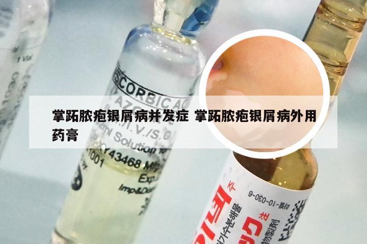 掌跖脓疱银屑病并发症 掌跖脓疱银屑病外用药膏