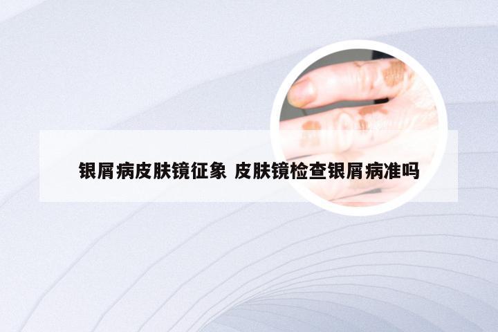 银屑病皮肤镜征象 皮肤镜检查银屑病准吗