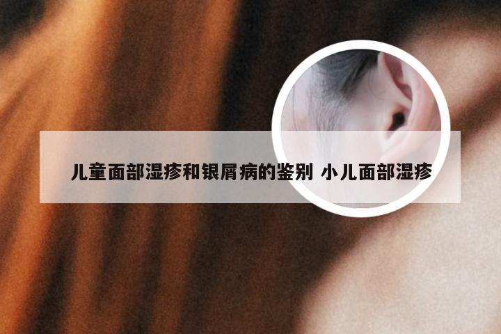 儿童面部湿疹和银屑病的鉴别 小儿面部湿疹