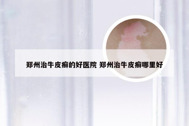郑州治牛皮癣的好医院 郑州治牛皮癣哪里好