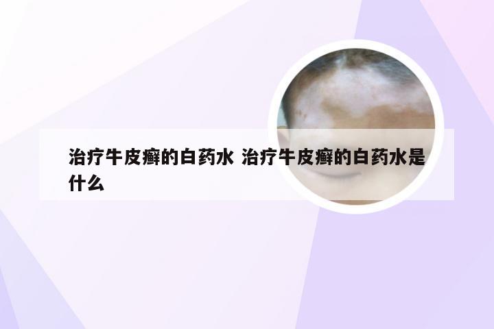 治疗牛皮癣的白药水 治疗牛皮癣的白药水是什么