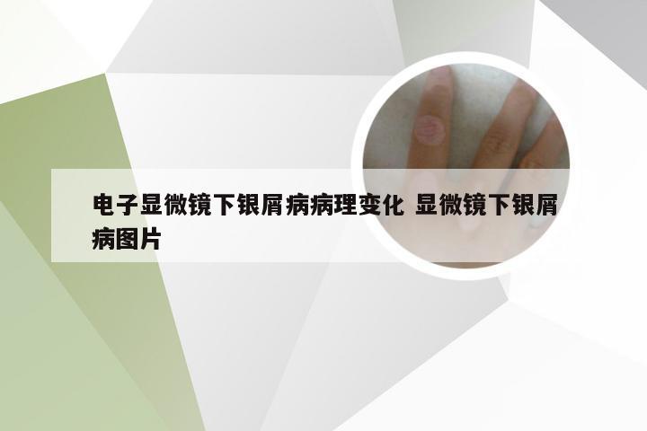 电子显微镜下银屑病病理变化 显微镜下银屑病图片