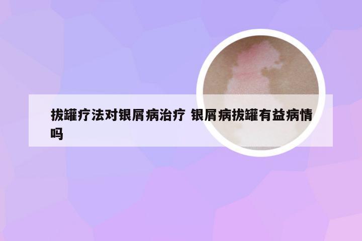 拔罐疗法对银屑病治疗 银屑病拔罐有益病情吗