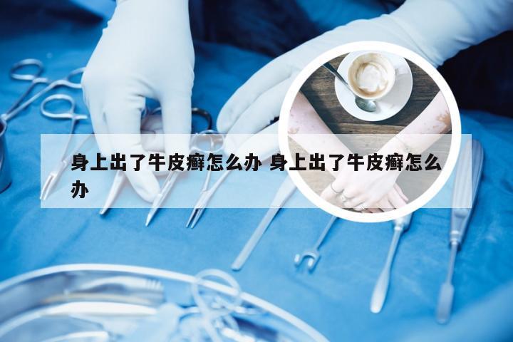 身上出了牛皮癣怎么办 身上出了牛皮癣怎么办