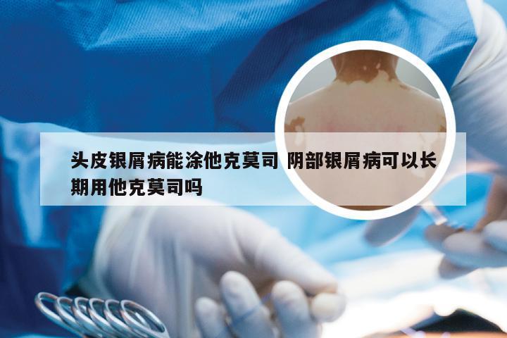 头皮银屑病能涂他克莫司 阴部银屑病可以长期用他克莫司吗