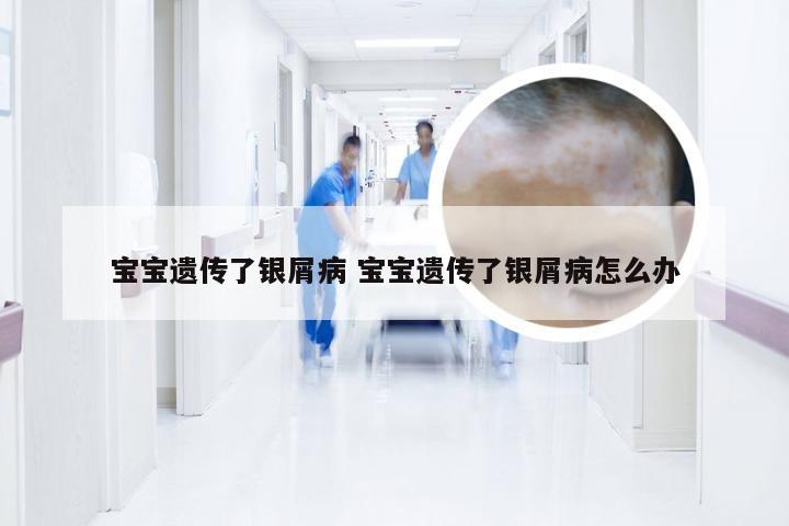 宝宝遗传了银屑病 宝宝遗传了银屑病怎么办