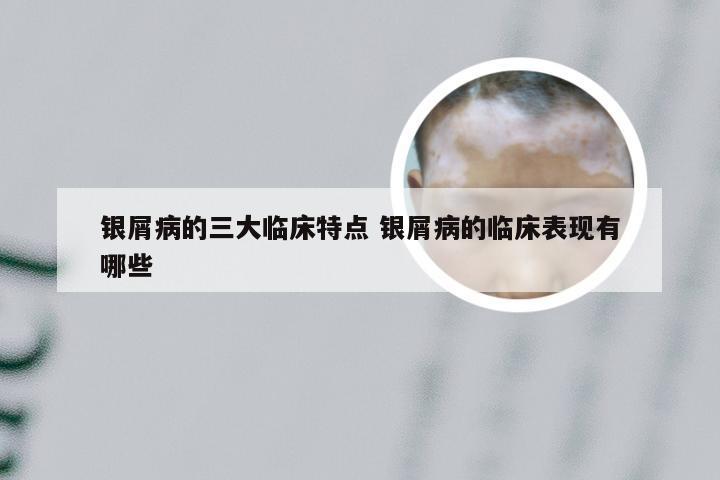 银屑病的三大临床特点 银屑病的临床表现有哪些