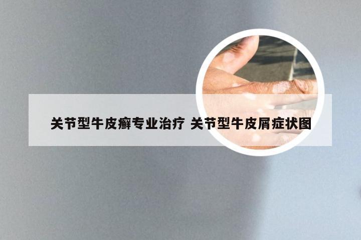 关节型牛皮癣专业治疗 关节型牛皮屑症状图