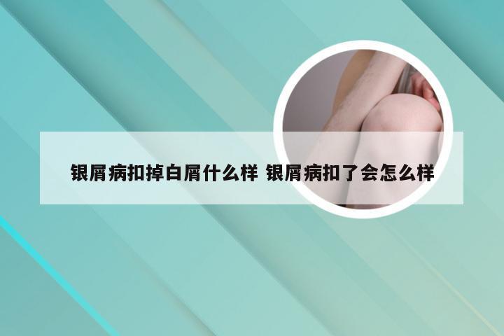 银屑病扣掉白屑什么样 银屑病扣了会怎么样
