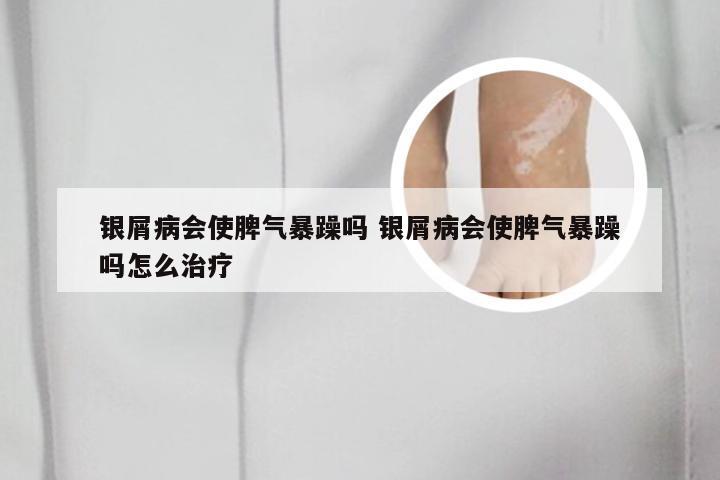 银屑病会使脾气暴躁吗 银屑病会使脾气暴躁吗怎么治疗