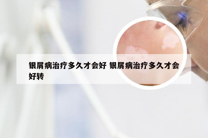 银屑病治疗多久才会好 银屑病治疗多久才会好转