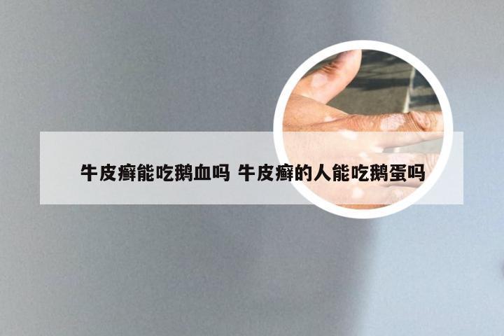 牛皮癣能吃鹅血吗 牛皮癣的人能吃鹅蛋吗