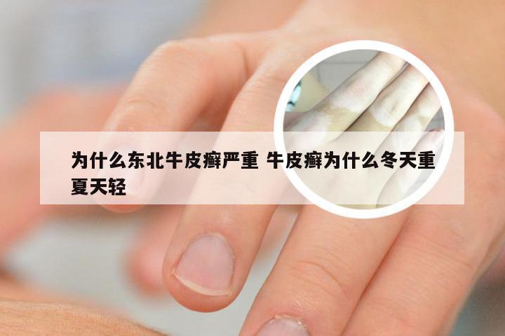 为什么东北牛皮癣严重 牛皮癣为什么冬天重夏天轻