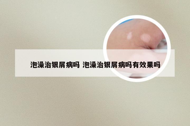 泡澡治银屑病吗 泡澡治银屑病吗有效果吗